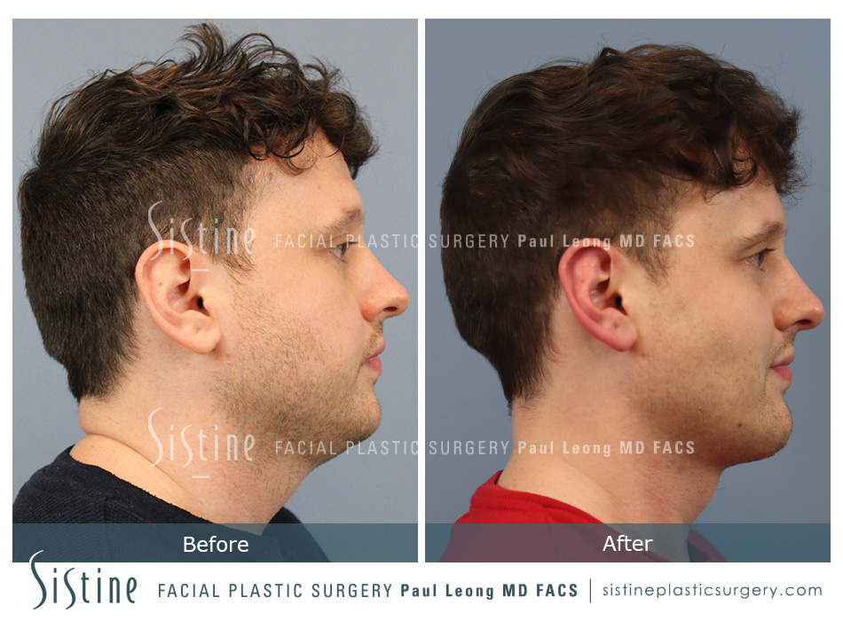 Chin Implant Before and After | Leong Facial Plastic Surgery