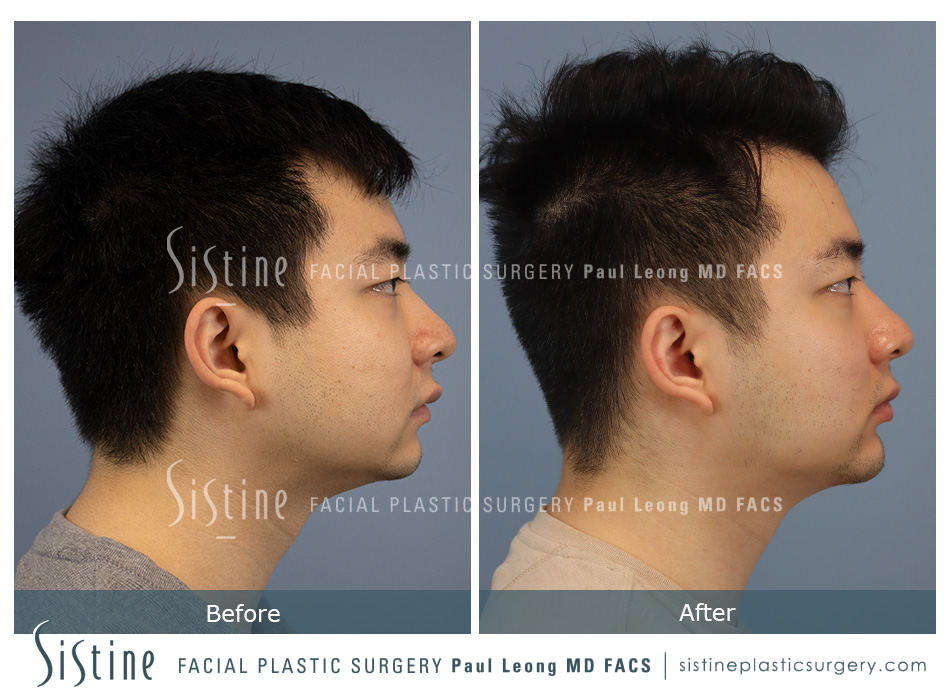 Chin Implant Before and After | Leong Facial Plastic Surgery