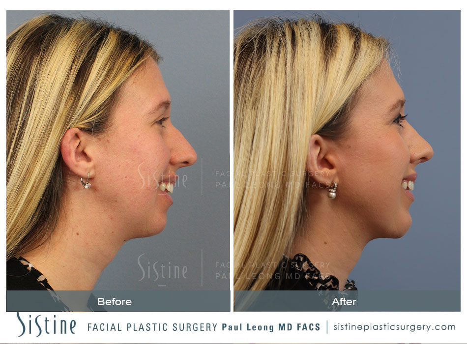 Chin Implant Before and After | Leong Facial Plastic Surgery