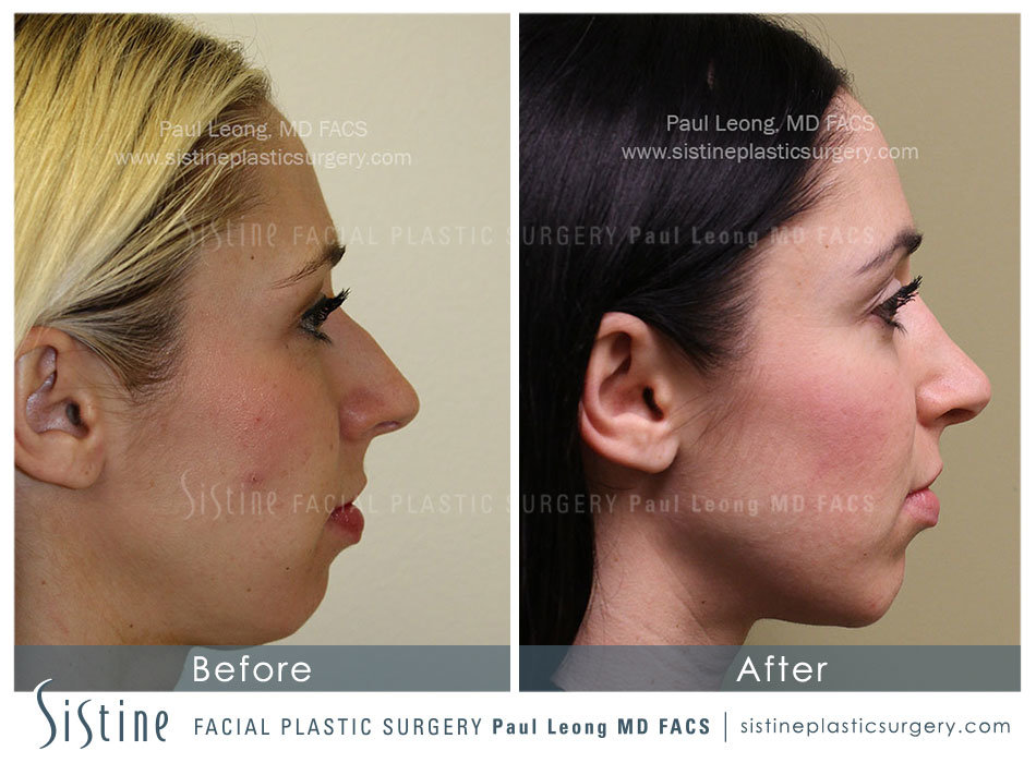 Chin Implant Before and After | Leong Facial Plastic Surgery