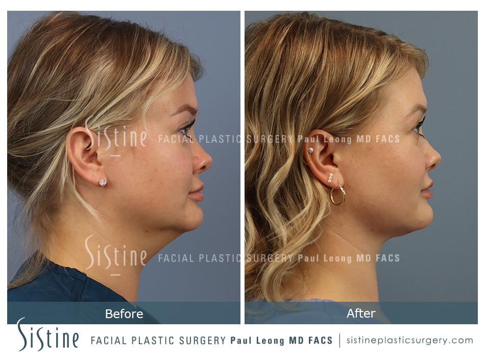 Deep Neck Lift Before and After | Leong Facial Plastic Surgery