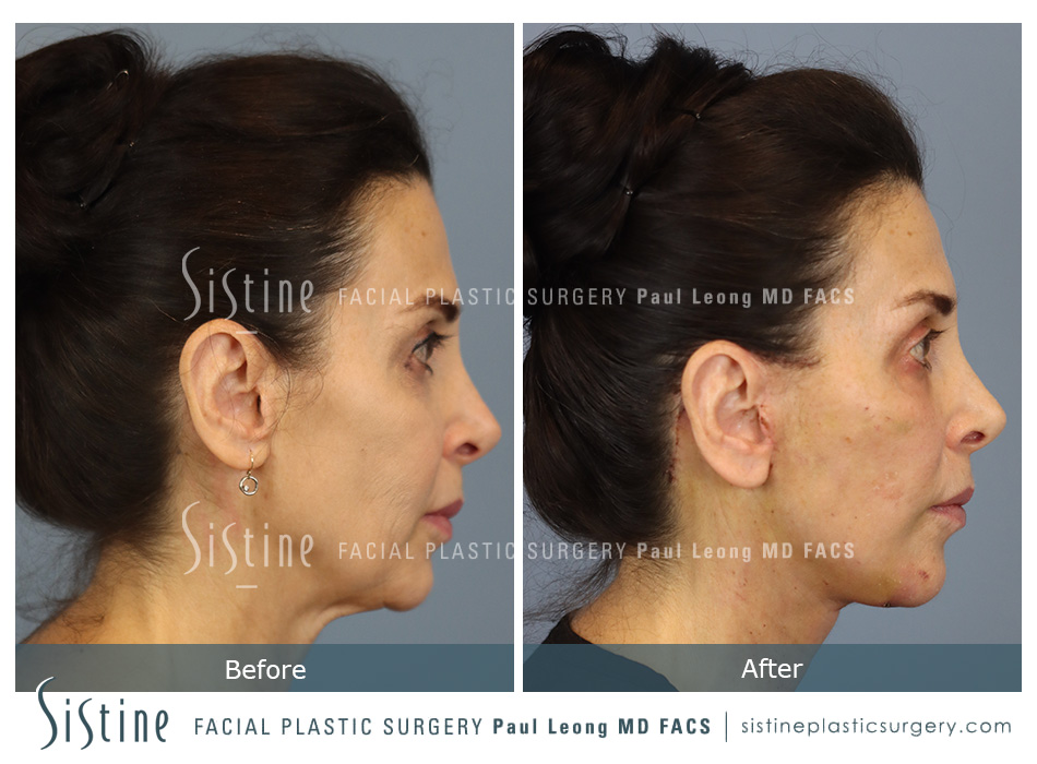 Deep Neck Lift Before and After | Leong Facial Plastic Surgery