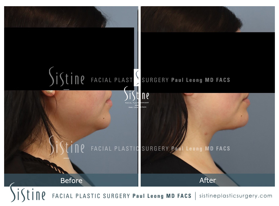 Deep Neck Lift Before and After | Leong Facial Plastic Surgery