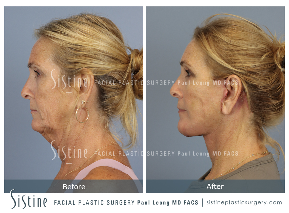 Deep Neck Lift Before and After | Leong Facial Plastic Surgery