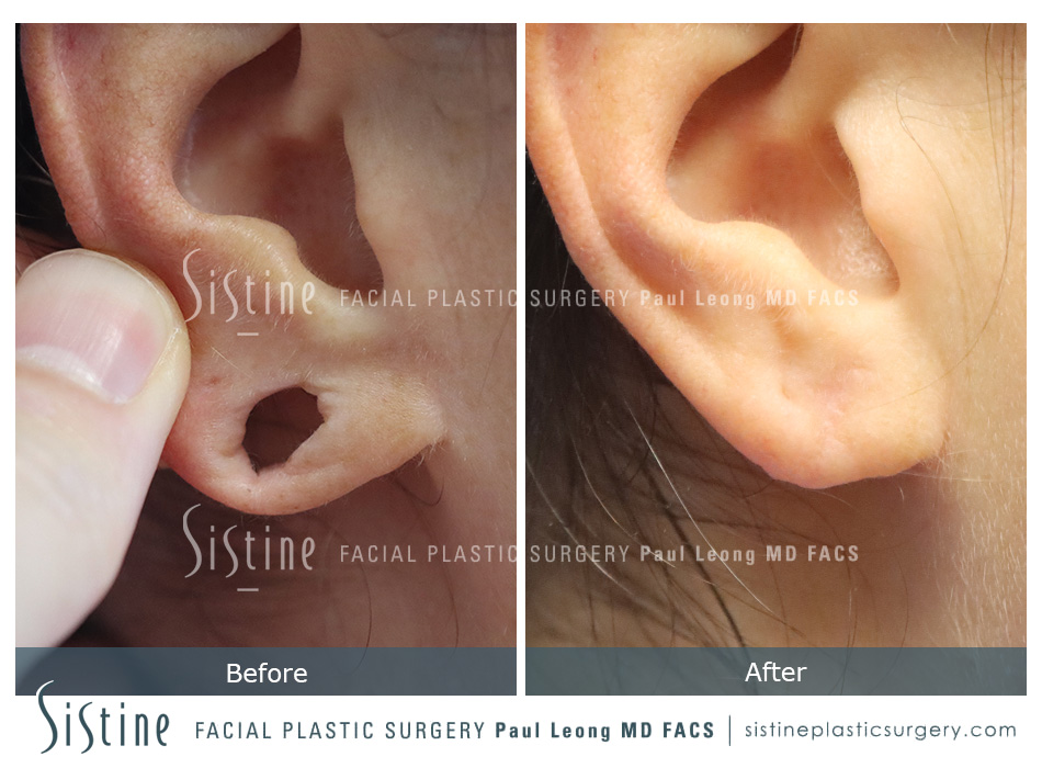 Earlobe Repair Before and After | Leong Facial Plastic Surgery