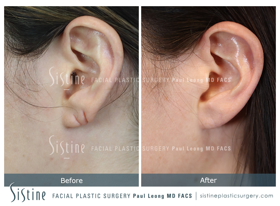 Earlobe Repair Before and After | Leong Facial Plastic Surgery