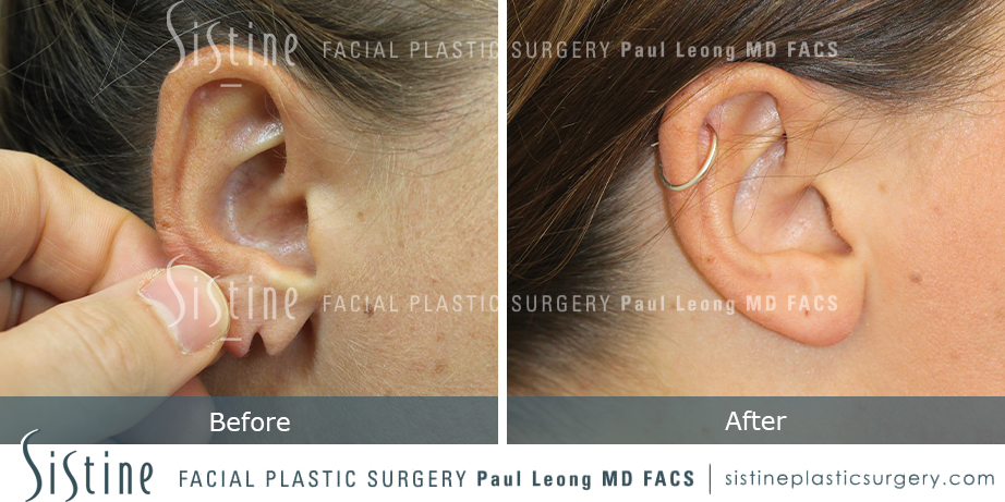 Earlobe Repair Before and After | Leong Facial Plastic Surgery