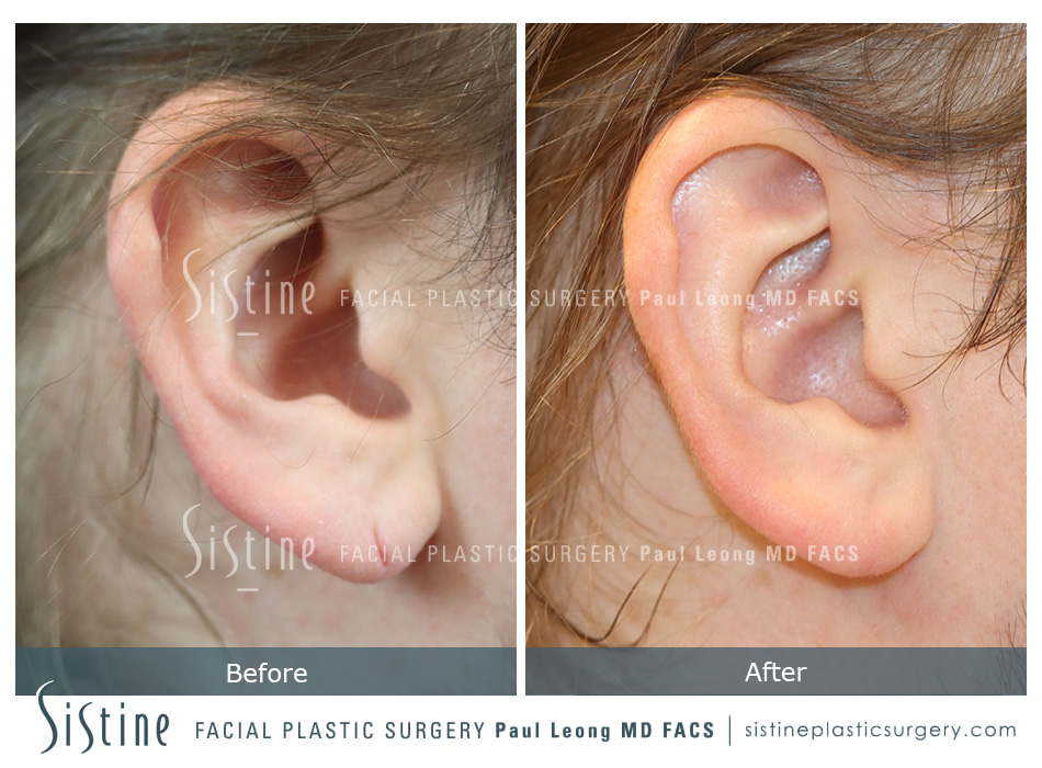 Earlobe Repair Before and After | Leong Facial Plastic Surgery