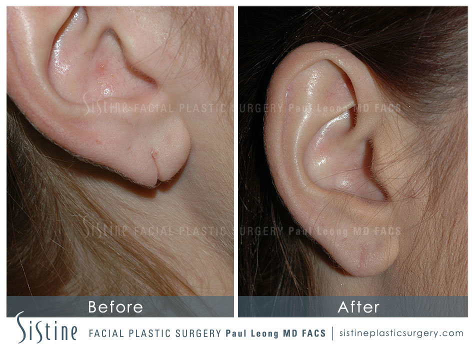 Earlobe Repair Before and After | Leong Facial Plastic Surgery