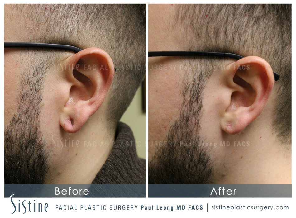 Earlobe Repair Before and After | Leong Facial Plastic Surgery