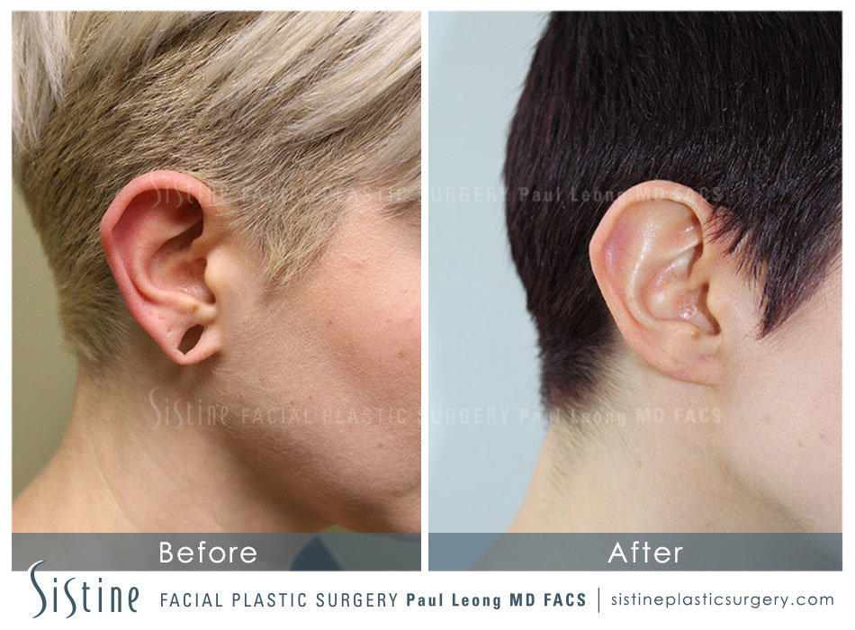 Earlobe Repair Before and After | Leong Facial Plastic Surgery