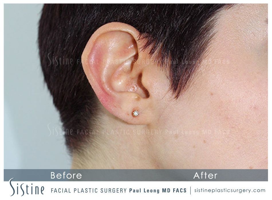 Earlobe Repair Before and After | Leong Facial Plastic Surgery