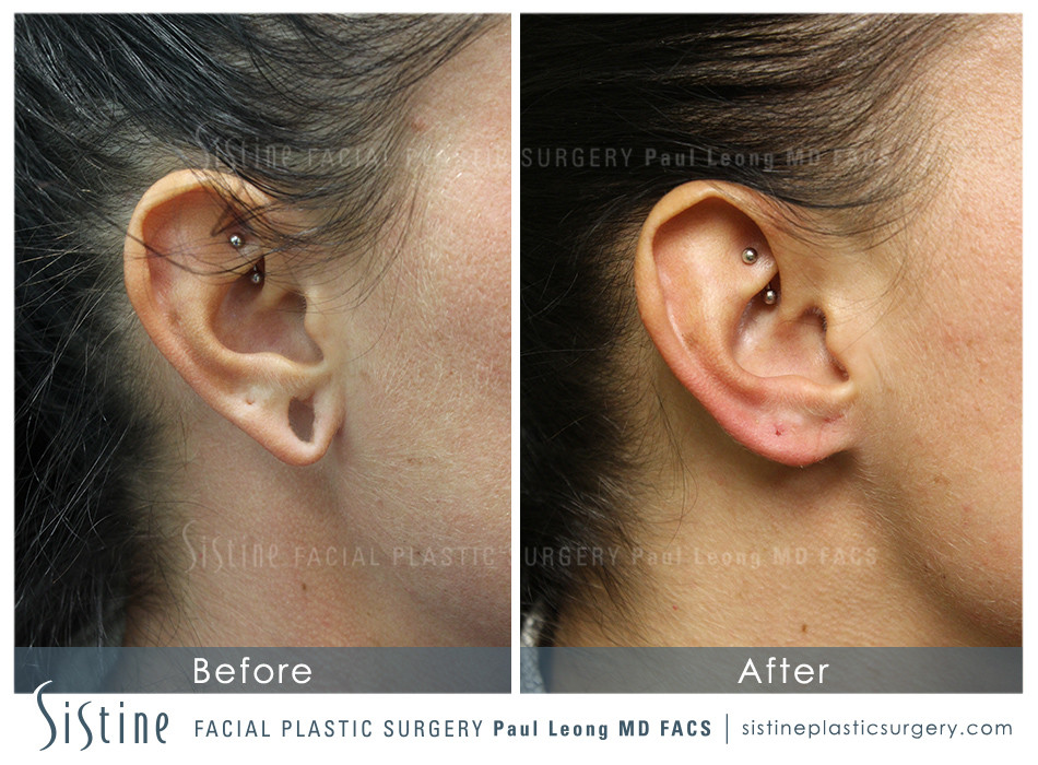 Earlobe Repair Before and After | Leong Facial Plastic Surgery