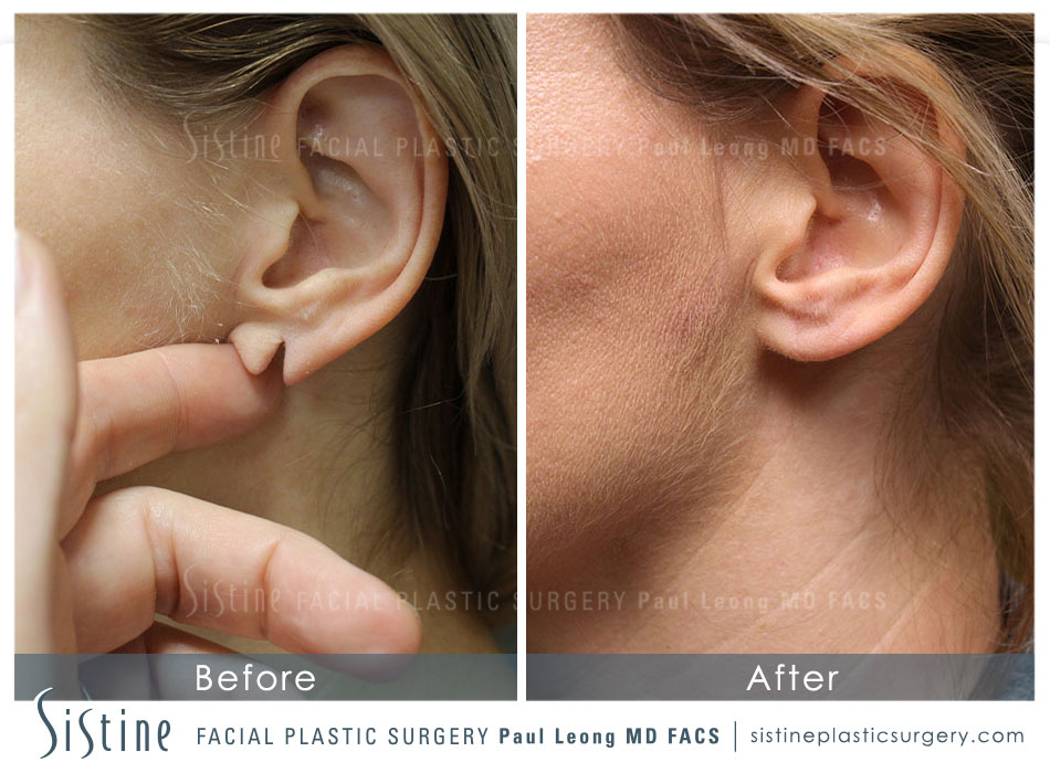 Earlobe Repair Before and After | Leong Facial Plastic Surgery