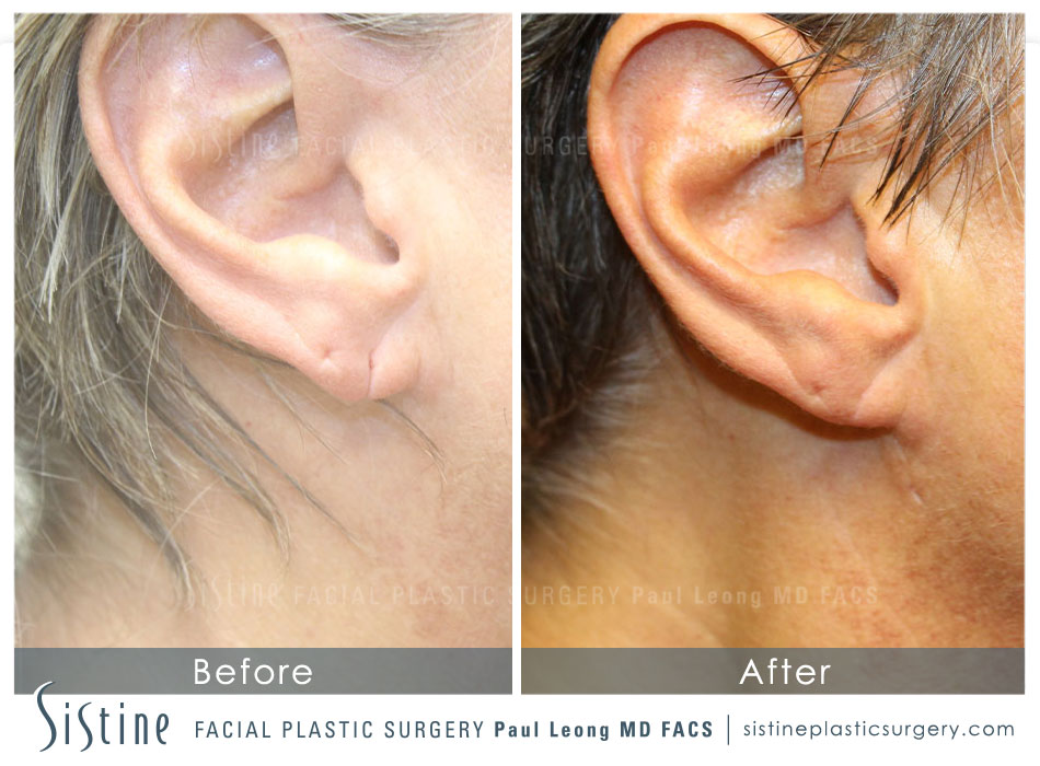 Earlobe Repair Before and After | Leong Facial Plastic Surgery