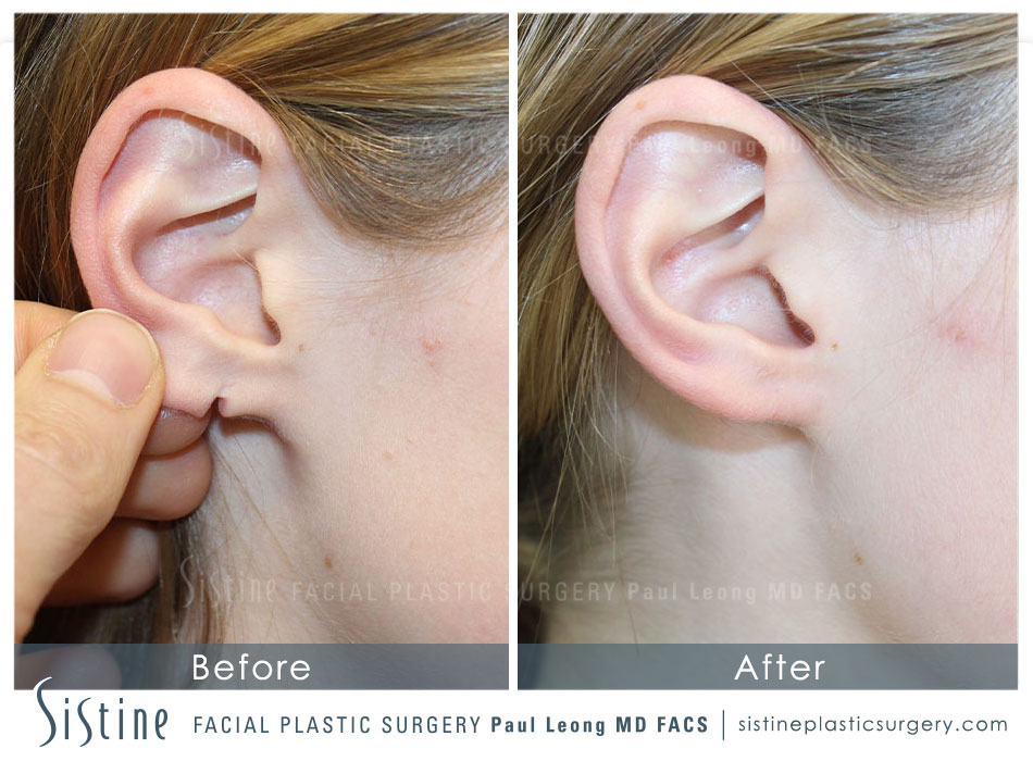 Earlobe Repair Before and After | Leong Facial Plastic Surgery