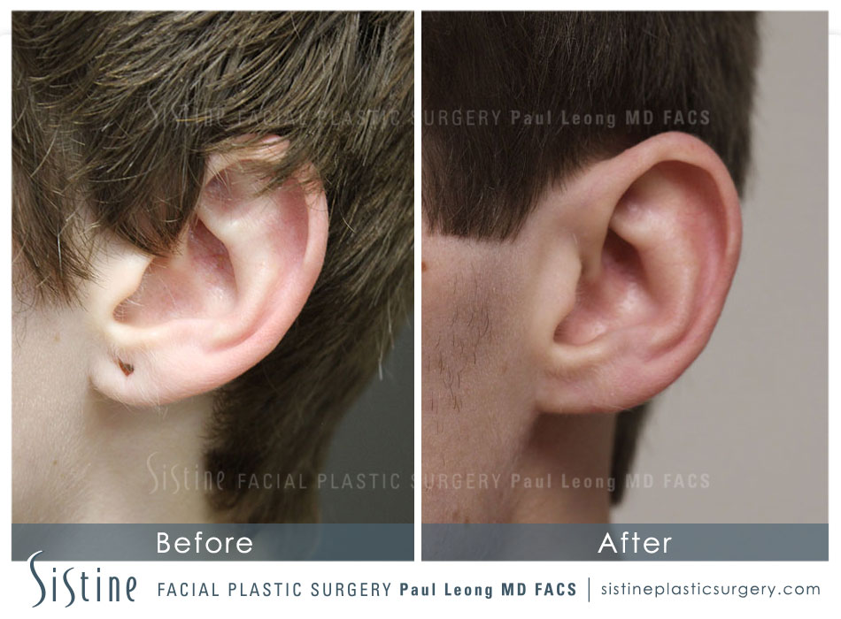 Earlobe Repair Before and After | Leong Facial Plastic Surgery