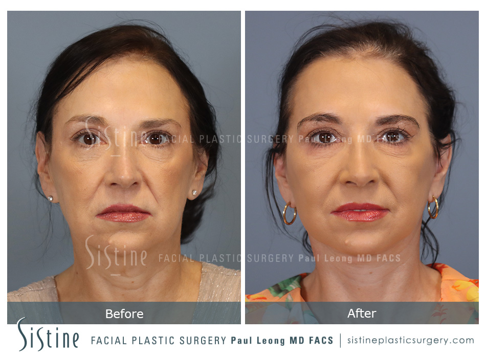 Facelift Before and After | Leong Facial Plastic Surgery