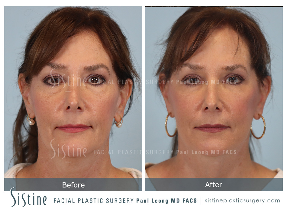 Facelift Before and After | Leong Facial Plastic Surgery