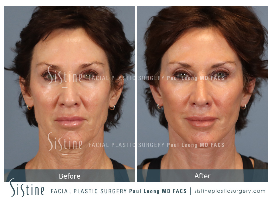 Facelift Before and After | Leong Facial Plastic Surgery