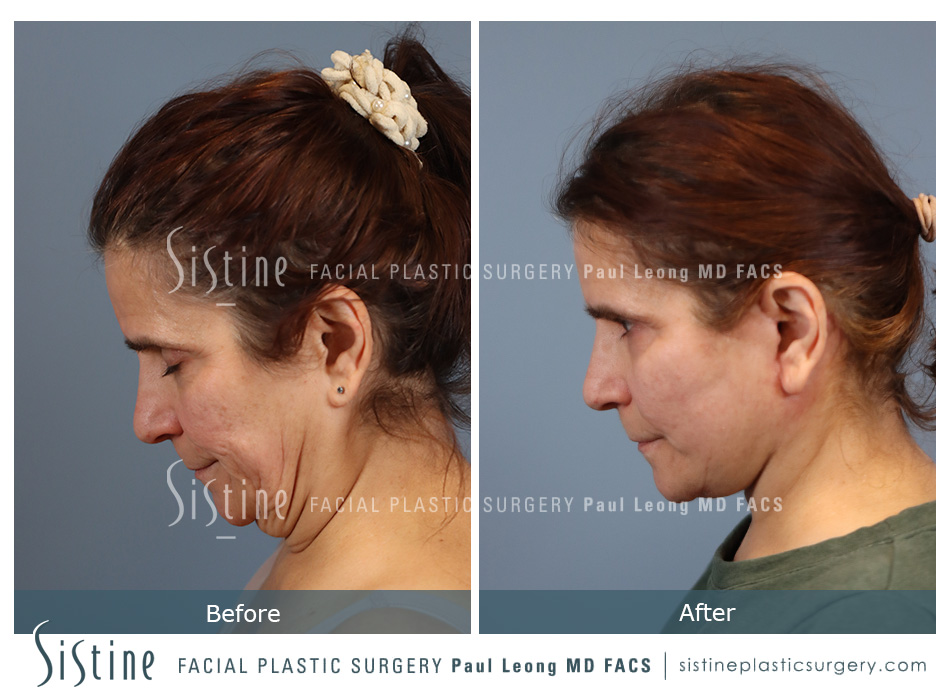 Facelift Before and After | Leong Facial Plastic Surgery