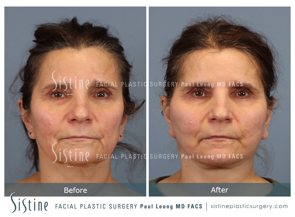 Facelift Before and After | Leong Facial Plastic Surgery