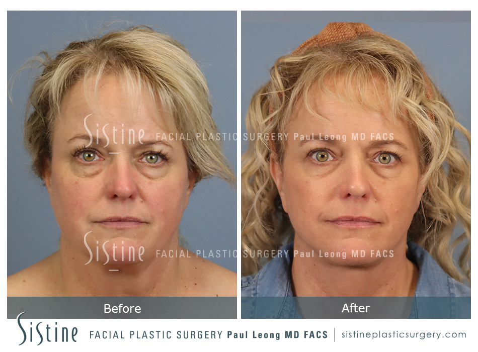 Facelift Before and After | Leong Facial Plastic Surgery