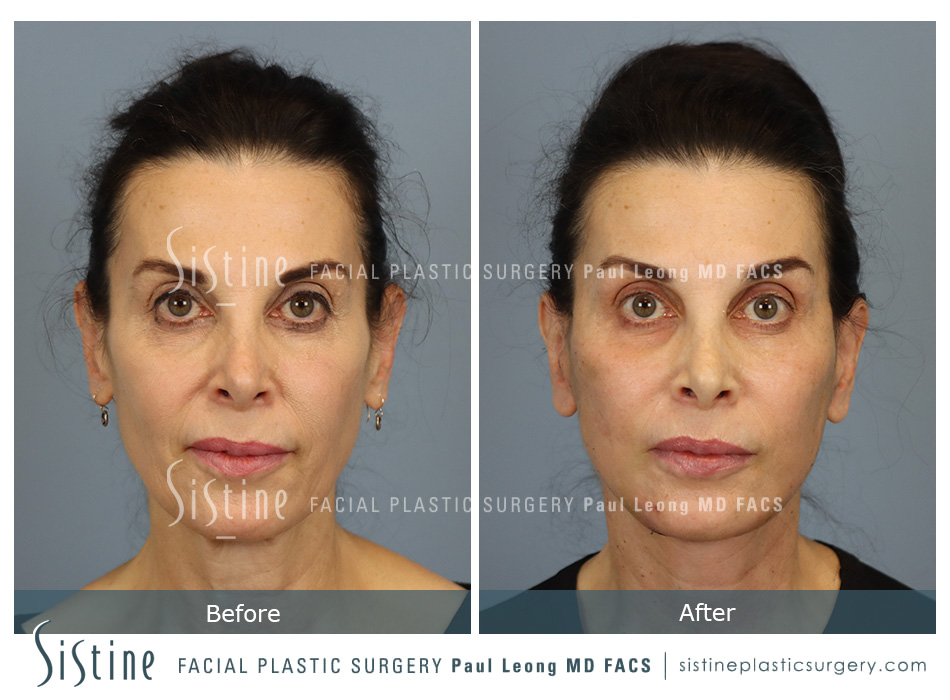 Facelift Before and After | Leong Facial Plastic Surgery