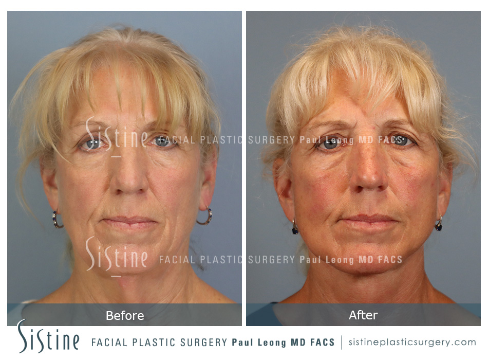 Facelift Before and After | Leong Facial Plastic Surgery