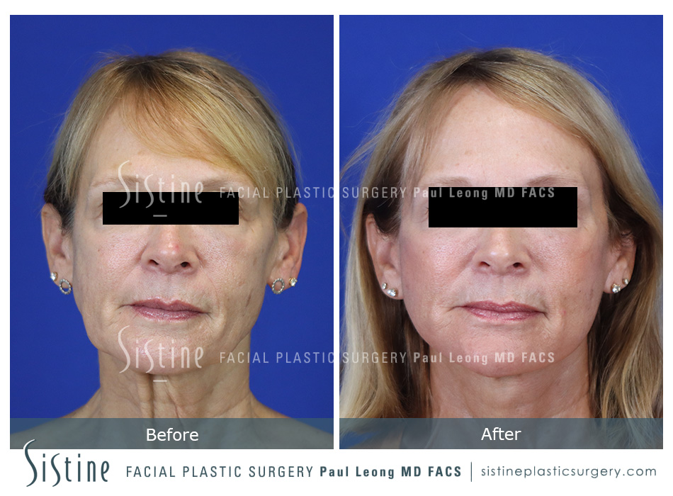 Facelift Before and After | Leong Facial Plastic Surgery