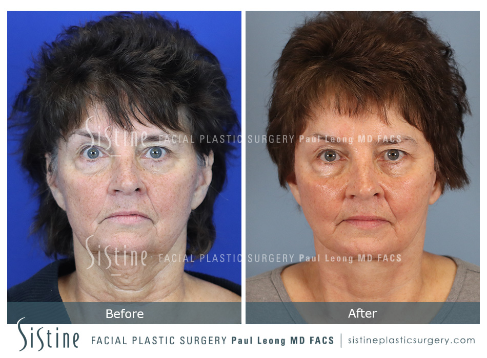 Facelift Before and After | Leong Facial Plastic Surgery