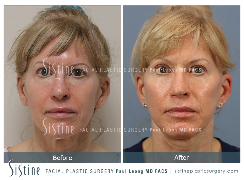 Facelift Before and After | Leong Facial Plastic Surgery