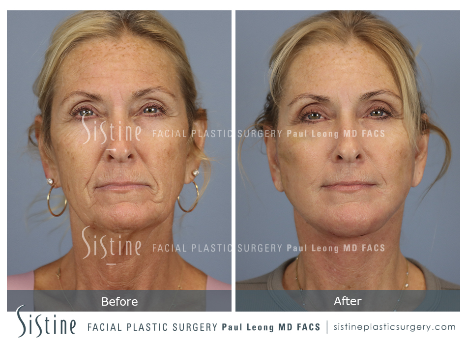 Facelift Before and After | Leong Facial Plastic Surgery