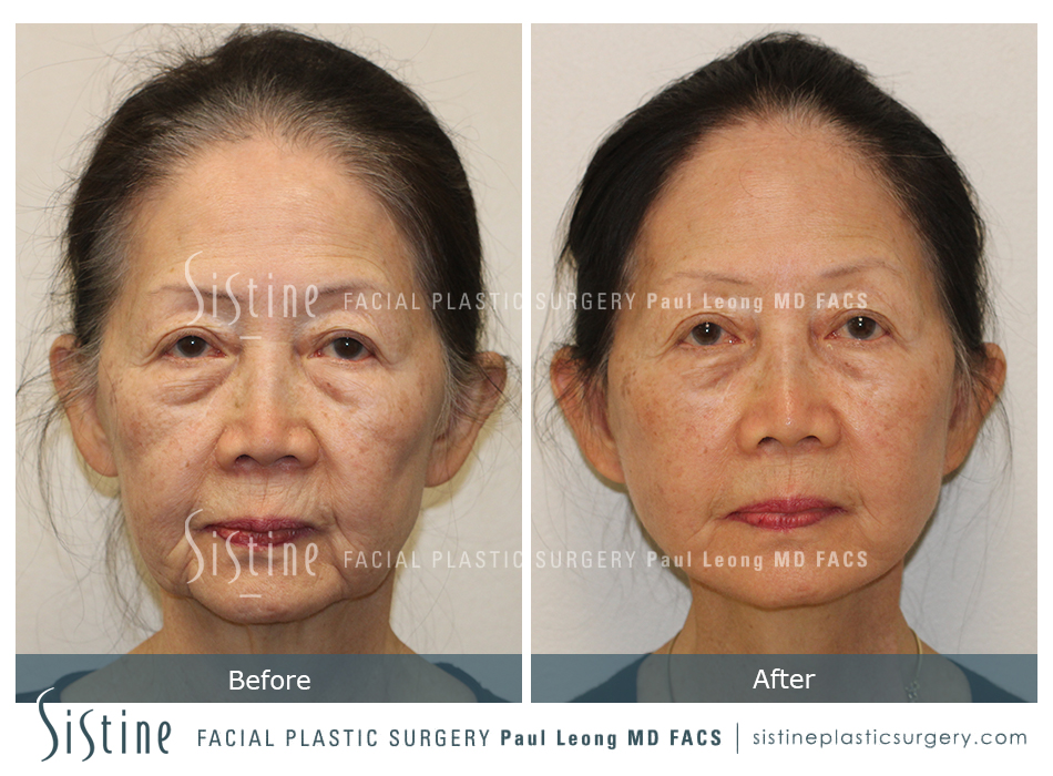 Facelift Before and After | Leong Facial Plastic Surgery