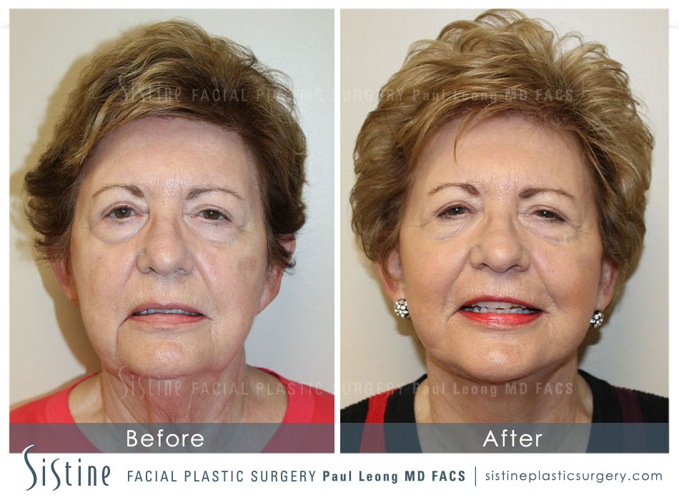 Facelift Before and After | Leong Facial Plastic Surgery