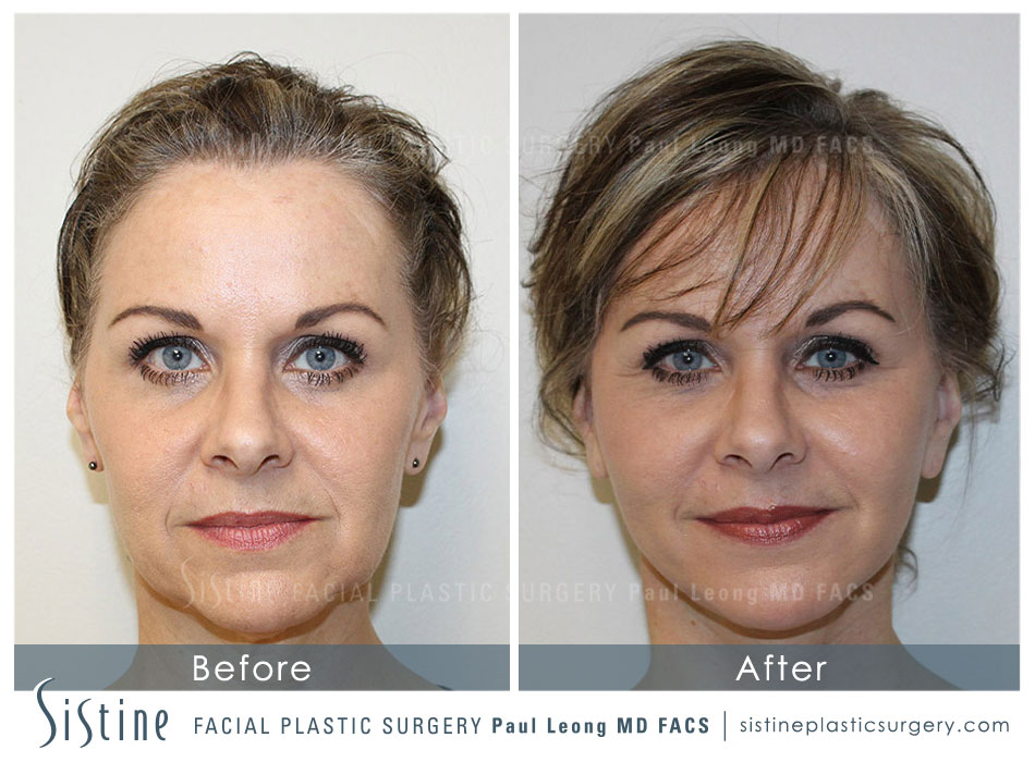 Facelift Before and After | Leong Facial Plastic Surgery