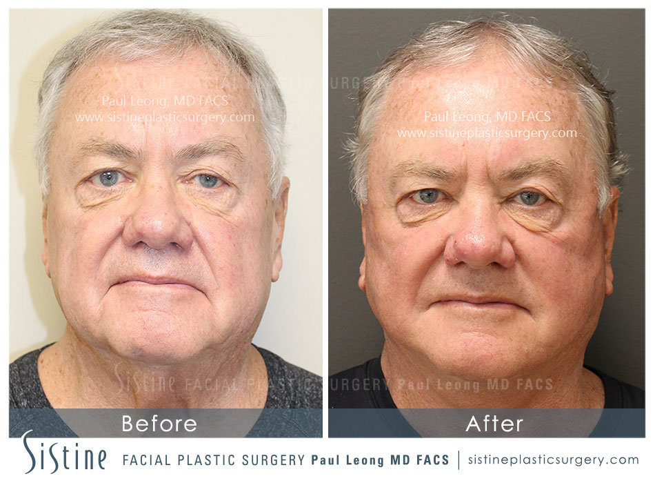 Facelift Before and After | Leong Facial Plastic Surgery