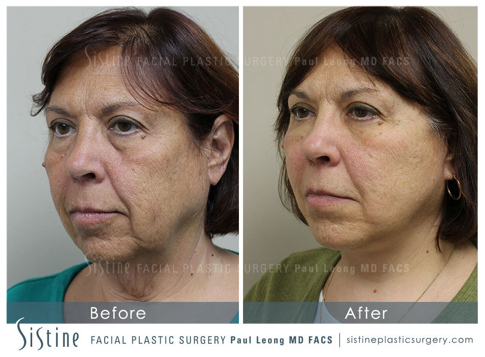 Facelift Before and After | Leong Facial Plastic Surgery