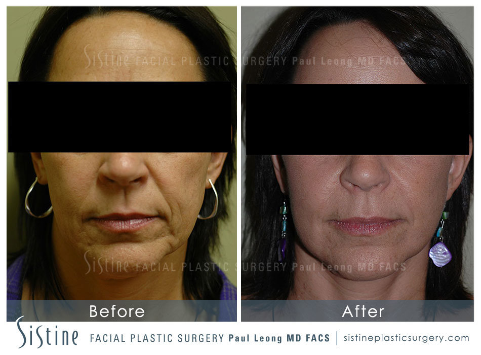 Facelift Before and After | Leong Facial Plastic Surgery