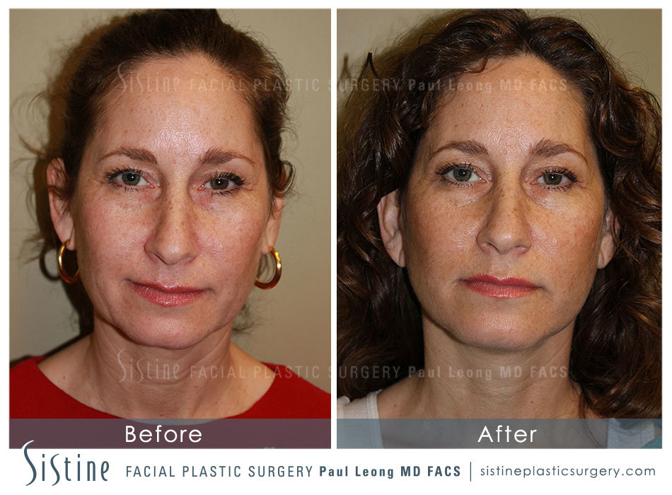 Facelift Before and After | Leong Facial Plastic Surgery