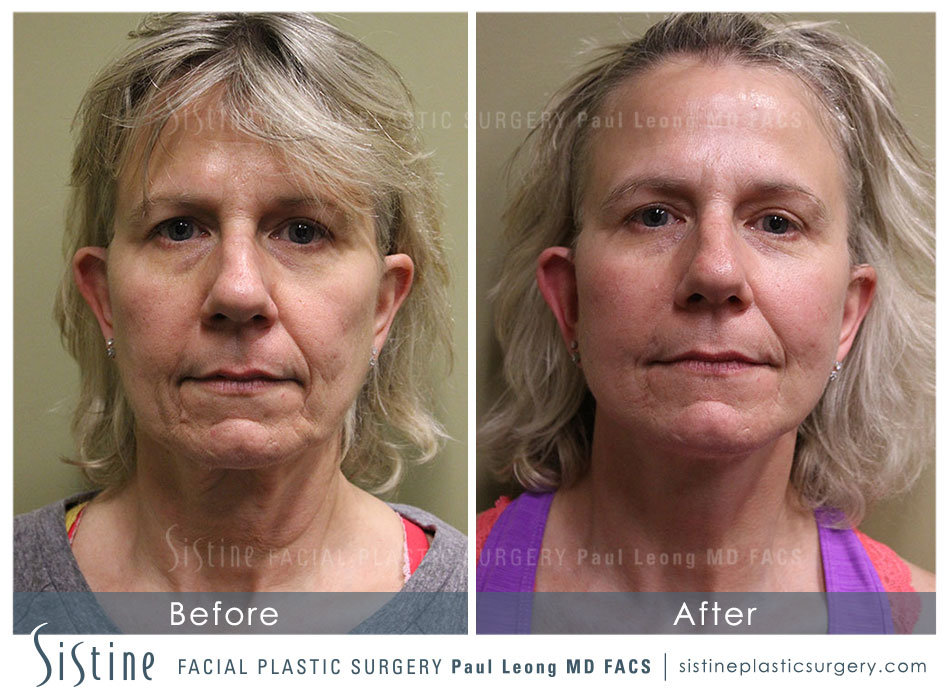 Facelift Before and After | Leong Facial Plastic Surgery