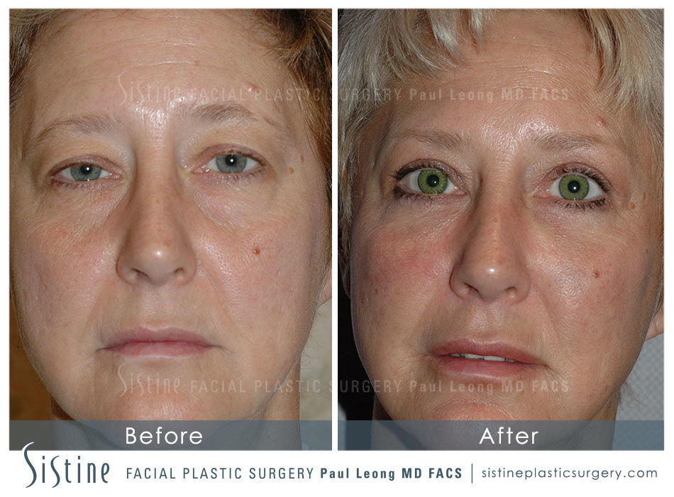 Fat Transfer Injections Before and After | Leong Facial Plastic Surgery