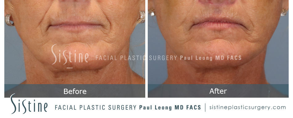 Lip Lift Before and After | Leong Facial Plastic Surgery