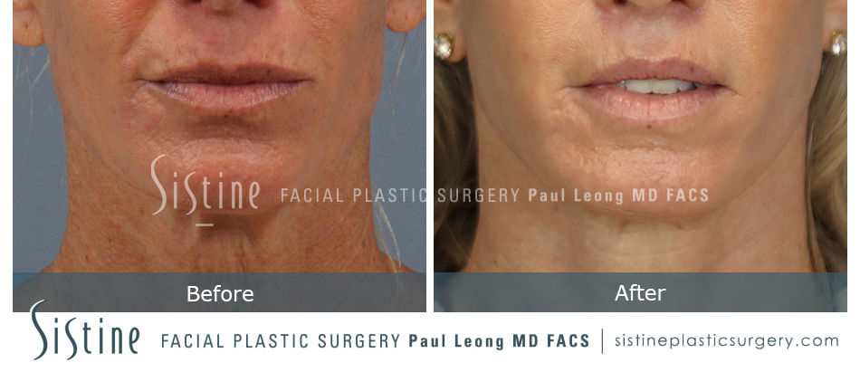 Lip Lift Before and After | Leong Facial Plastic Surgery