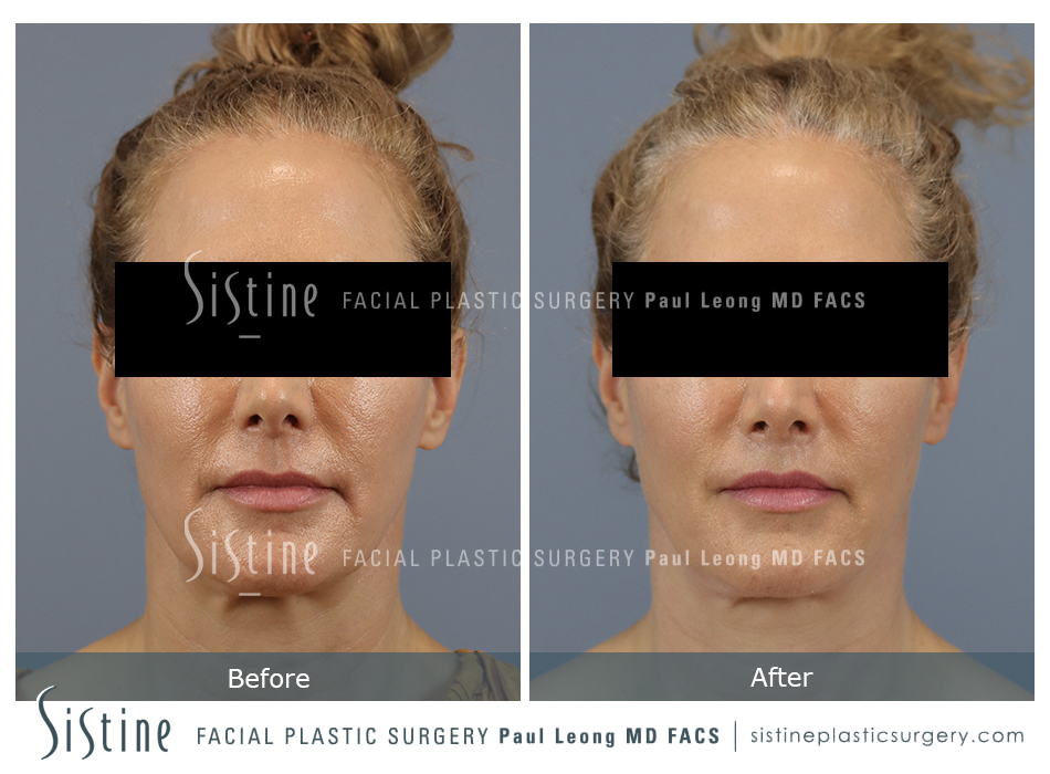 Lip Lift Before and After | Leong Facial Plastic Surgery