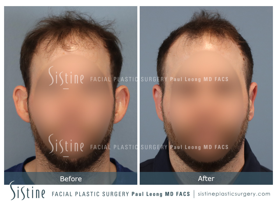 Otoplasty Before and After | Leong Facial Plastic Surgery