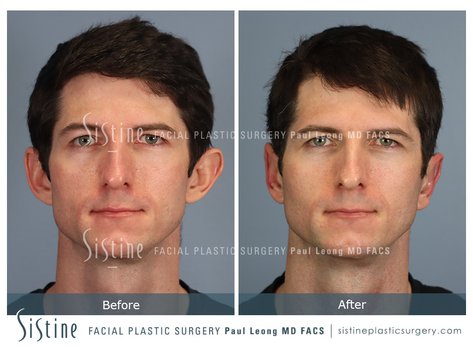 Otoplasty Before and After | Leong Facial Plastic Surgery