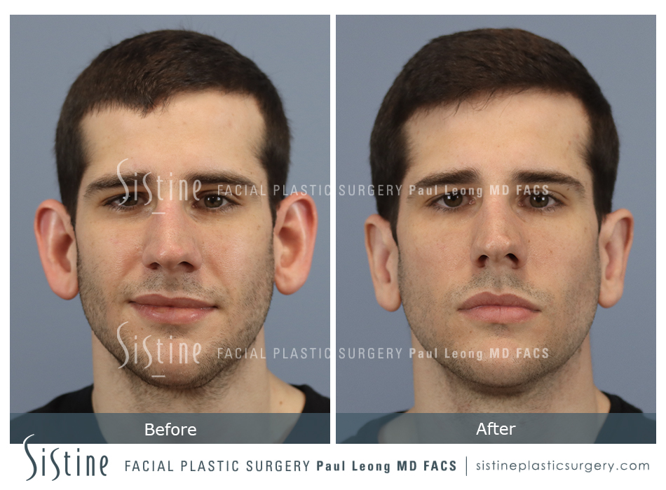 Otoplasty Before and After | Leong Facial Plastic Surgery