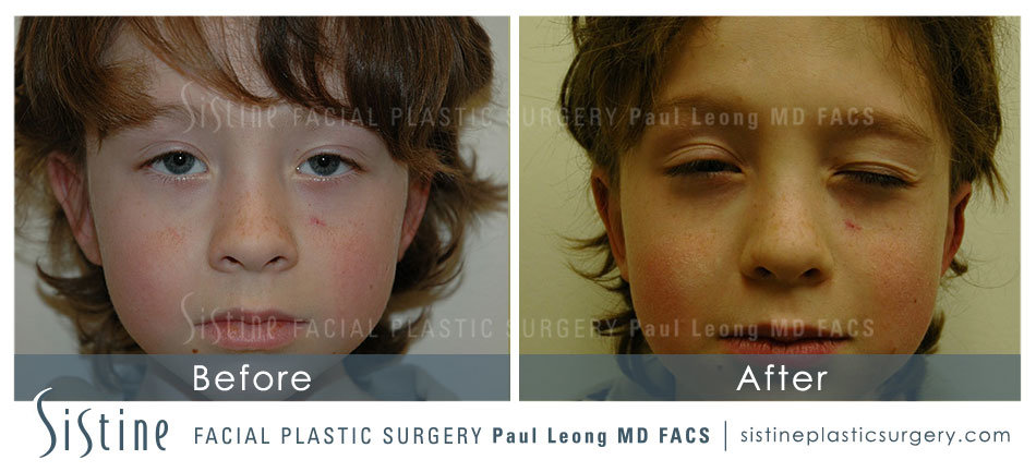 Otoplasty Before and After | Leong Facial Plastic Surgery