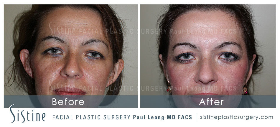 Otoplasty Before and After | Leong Facial Plastic Surgery